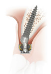 SATURNO Narrow Diameter Implant System