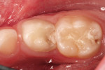 Figure 1 Pretreatment view. Tooth L will be extracted at the next visit.