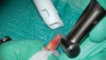 A 3-mm apicoectomy was performed using a 1557 SaberCut Bur.