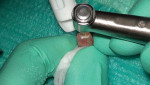 Retropreparation was performed using a #2 surgical-length slow-speed bur to a depth of 3 mm, connecting the isthmus in this oval canal.