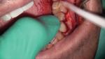 After suctioning the clot in the socket, the tooth was repositioned back in the socket and some pressure was applied.