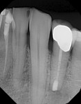 The 6-month recall radiograph shows complete healing of the apex.