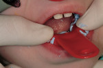 Figure 6 The impression tray is placed into the mouth. A quadrant tray could also be used for a BAL space maintainer.