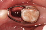Figure 10 The BAL space maintainer is cemented immediately using a resin-modified glass ionomer cement.