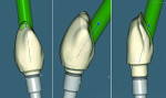 Fig 3. Wax-up, ASC screw-access correction, and digital cutback.