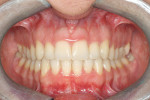 Figure 4H Posttreatment frontal intr oral photograph; the deep bite has improved from an initial 65% of lower incisor coverage to 8%.