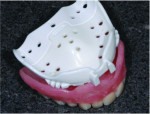 Fig 1 and 2. Select a tray that is closest to a denture that would fit the edentulous ridge. A common mistake is choosing a tray that overextends the vestibule.