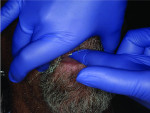 Fig 3 and 4. A two-step process was used for taking the upper and lower impressions. This included a border-molding procedure.