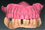 Fig. 9 through Fig 11. The now digital
impression was sent to the Heraeus Kulzer Pala Design Center to create 3D renderings of the denture and print a try-in. Once the try-in was approved, the final denture was created.