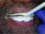 Fig 8. After the centric was in position, bite registration material was extruded to record the patient’s proper bite.