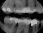 Pretreatment full-mouth radiograph series of patient who was experiencing extreme discomfort and sensitivity from dry mouth. Note the rampant caries and gingival recession.