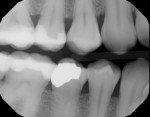 Pretreatment full-mouth radiograph series of patient who was experiencing extreme discomfort and sensitivity from dry mouth. Note the rampant caries and gingival recession.