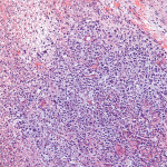 Figure 2 High-power atypical cells were positive for B-cell marker (magnification 100x).