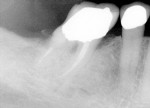 Figure 4  Postoperative radiograph of tooth No. 30.