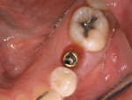 Figure 6  Implant installed at site No. 20.