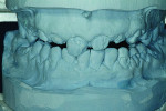 Fig 6 through Fig 8. This immediate digital
denture process began with scanning the
master casts.