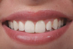 Smile at 28 months post treatment. The amount of tooth display has remained stable, allowing a normal 80% crown width-to-height ratio in the central incisors.