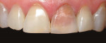 Tooth with pre-existing resin composite veneer removed, showing loss of enamel and deeply discolored dentin.