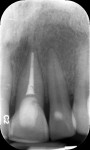 Radiographic appearance of tooth in Figure 1 showing large access restored with resin composite.