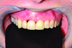 Figure 8 Esthetic re-evaluation with an ideal fixed temporary provisional. Significant soft tissue defects were noticed. (Fig 8 and Fig 9 courtesy of William Heggerick, DDS, prosthodontist, and Yuki Momma, RDT, Weston, Massachusetts)