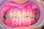 Figure 4 Retracted view, 3 months following the accident with temporization. Conservative initial surgical debridement was performed in order to avoid a collapse of both the alveolar ridge and soft tissue. There was no osteoclastic activity at this time. Intentional endodontic therapy was rendered on teeth Nos. 7 and 9.