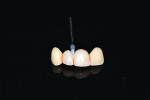 Figure 9 Esthetic re-evaluation with an ideal fixed temporary provisional. Significant soft tissue defects were noticed. (Fig 8 and Fig 9 courtesy of William Heggerick, DDS, prosthodontist, and Yuki Momma, RDT, Weston, Massachusetts)