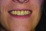 Figure 18 Patient’s smile at 1.5-year follow-up.