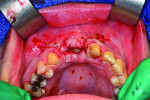 Figure 15 3-mm healing abutment was placed in order to provide a “framework” for epithelization to occur coronally (semi-submerged technique).