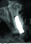 Figure 16 CBCT revealed 3-dimensionally sound implant placement No. 8; for optimum esthetic outcome, only a single implant for No. 8 was placed cantilevering pontic No. 7, avoiding central-lateral esthetic dilemma.