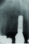 Figure 17 CBCT revealed 3-dimensionally sound implant placement No. 8; for optimum esthetic outcome, only a single implant for No. 8 was placed cantilevering pontic No. 7, avoiding central-lateral esthetic dilemma.