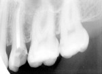 Figure 10  Postoperative radiograph showing filled tooth No. 13, Case 2.