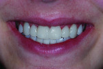 Figure 7 After veneers were aligned, the facial, incisal, and lingual aspects were each cured for 20 seconds.