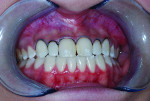 Figure 4 After an impression was taken and a model was produced to help with veneer contouring, the patient was numbed and cord was packed.