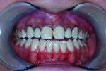 Figure 5 Teeth Nos. 5 through 12 were prepared. Contacts were opened and the facial was reduced by about 0.4 mm. Veneers were trimmed, mainly reducing the gingival area to shorten the veneer, starting with the central incisors, then the lateral incisors, the canines, and, finally, the premolars. A veneer bonding agent was applied to the veneer and light-curing was done for 10 seconds per tooth for proper adhesion. Phosphoric acid was applied and then rinsed thoroughly, followed by application and light-curing of enamel bond. Each veneer was roughed inside, rinsed, and dried.