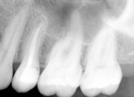Figure 11  Postoperative radiograph of the final fill in tooth No. 13, Case 2.