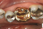 Figure 3  Pretreatment of a perforated gold crown previously repaired with amalgam.