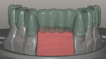 Figure 5 Virtual design of mandibular provisional restoration.