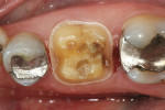 Figure 4  CEREC crown preparation after removal of the remaining restorative material.