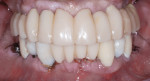 Figure 6 Intraoral frontal view of maxillary and mandibular provisionals, phase 2.