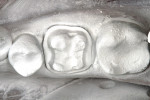 Figure 5  Crown preparation after application of the titanium dioxide powder.