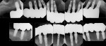 Figure 16 Post-treatment full-mouth radiographs.