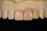 Figure 9 Fabrication of study cast for assessment and also used to produce a diagnostic waxing, replacing the hard tooth tissue on No. 8, and waxing a replacement tooth for No. 9.