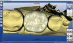 Figure 9  Completed crown design on the CEREC 3D software program.