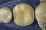 Figure 13a  Adhesive CEREC onlay relying maximally on the adhesive luting agent for retention.