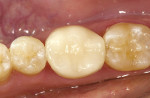 Figure 13b  Adhesive CEREC onlay relying maximally on the adhesive luting agent for retention.