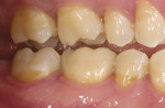 Figure 13c  Adhesive CEREC onlay relying maximally on the adhesive luting agent for retention.