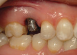 Figure 2 The titanium abutment made the overlying tissue appear discolored.