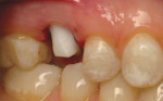 Figure 4 Duplicate zirconia abutment replacing the titanium abutment. Note the improved appearance of the tissue color.