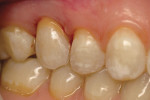 Figure 5A and Figure 5B Original all-ceramic crown placed on the zirconia abutment, improving the overall esthetic appearance of the restoration.