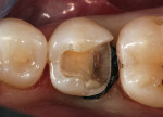 Figure 14  CEREC preparation with some degree of internal resistance to support the adhesive luting retention.